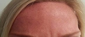 Botox and Dysport