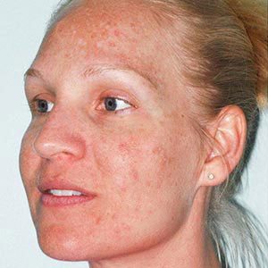 Corrective Chemical Peels