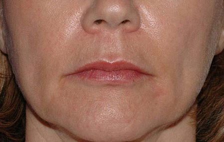 Juvederm