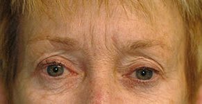 botox botox