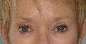 botox botox
