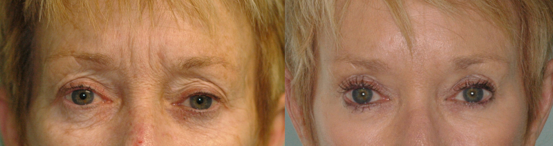 Botox treatments to reduce their appearance