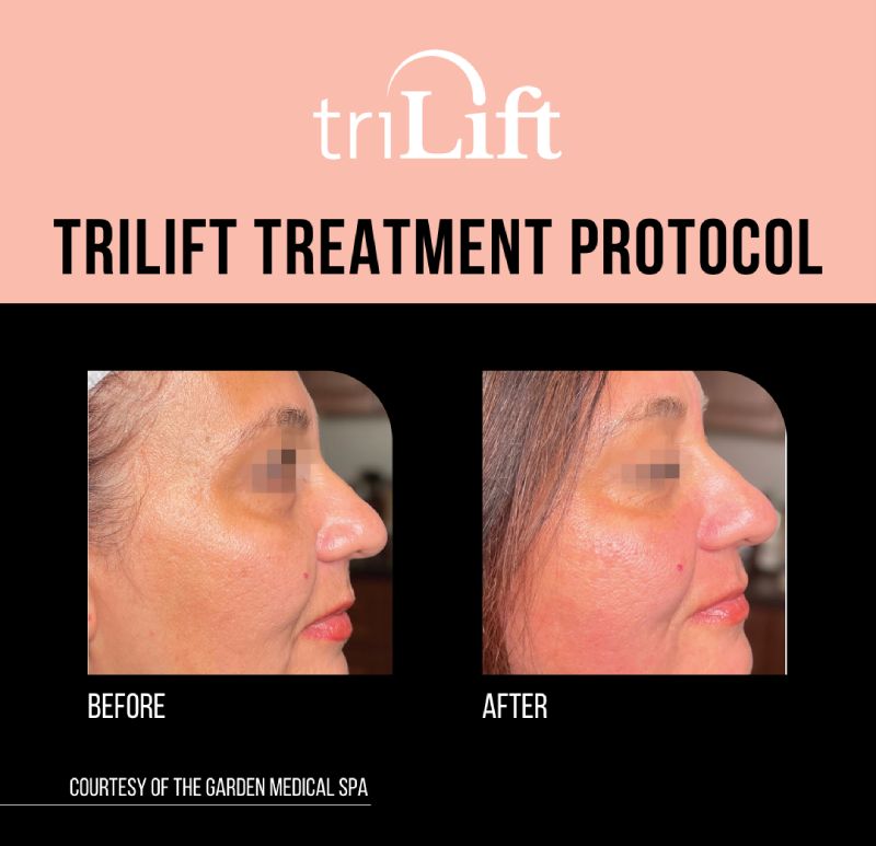 TRILIFT-TOOLKIT