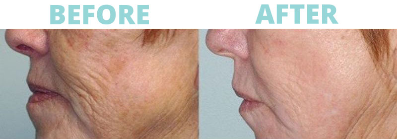Filler-Cheeks1 botox