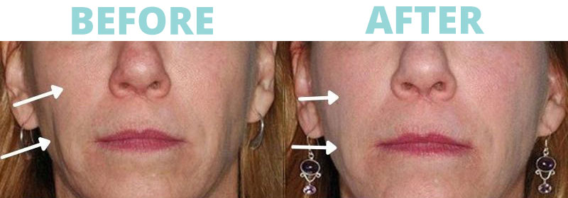 Filler-Cheeks2 botox