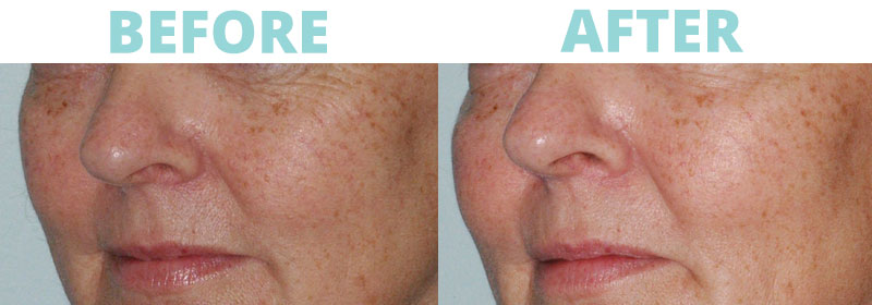 Filler-Cheeks3 botox