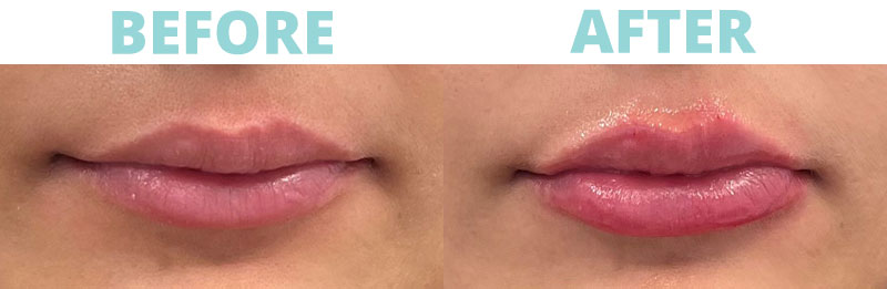 Filler-Lips11 botox