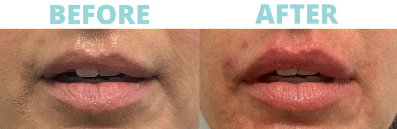 Filler-lips10 botox