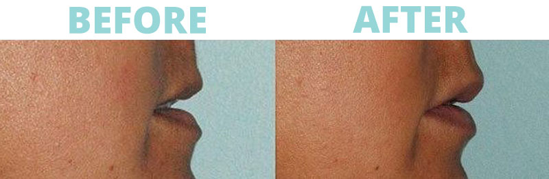 Filler-lips5 botox