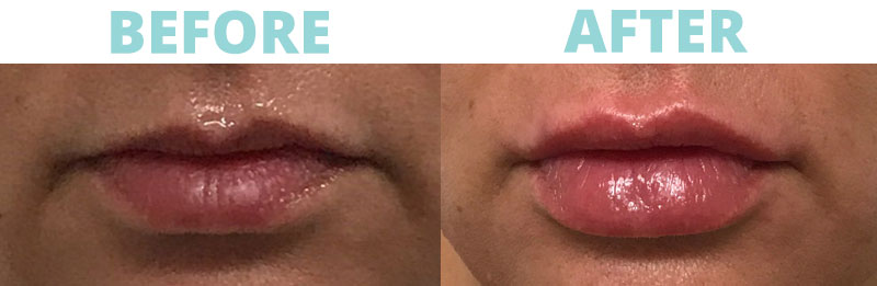 Filler-lips6 botox
