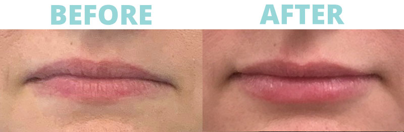 Filler-lips8 botox