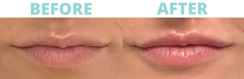 Filler-lips9 botox