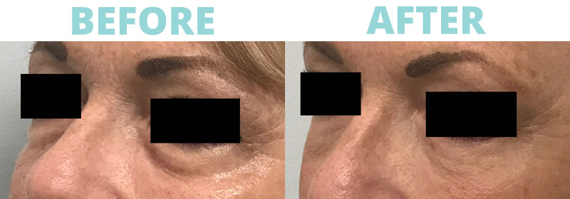 Filler-under-eye1 botox