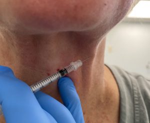Platsymal Bands/Neck Creases