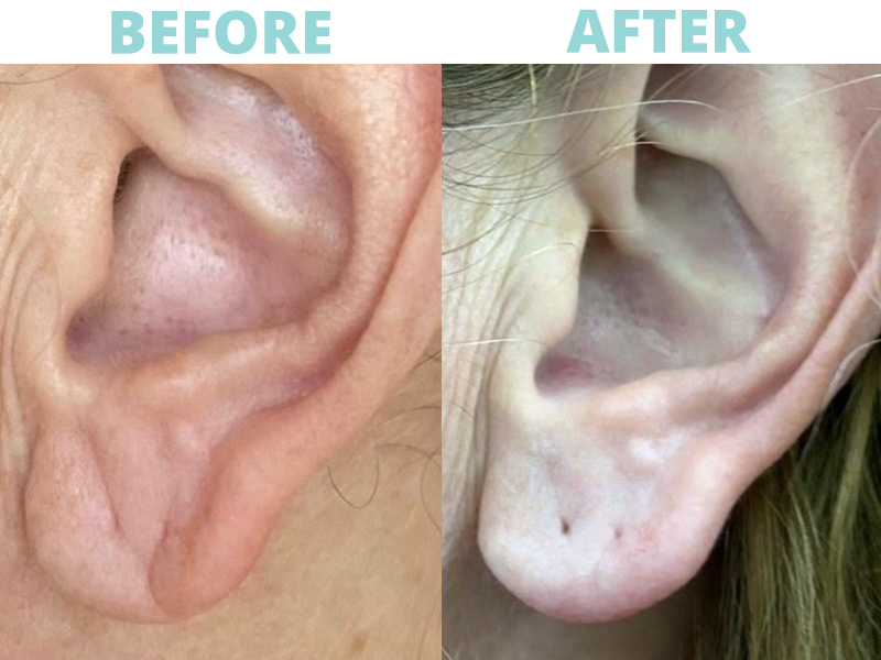 Filler-Cheeks5 botox