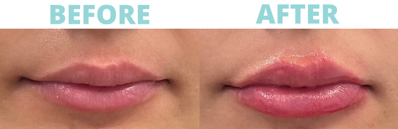 botox botox