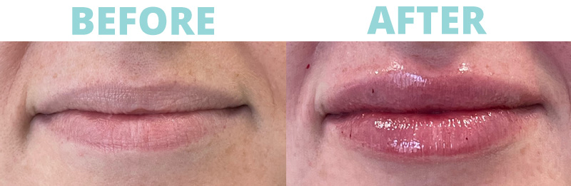 Filler-Lips11 botox