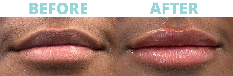 botox botox