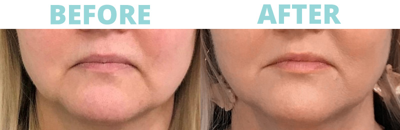Filler-Cheeks5 botox