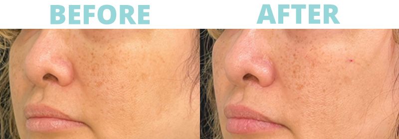 Filler-Cheeks4 botox
