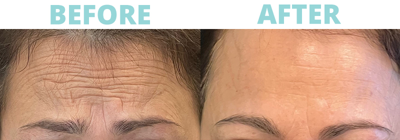 Botox