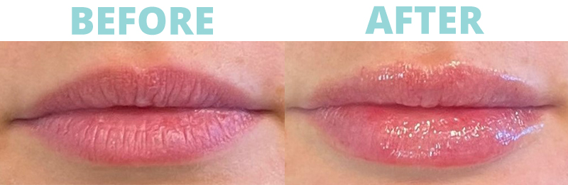 Lip Filler