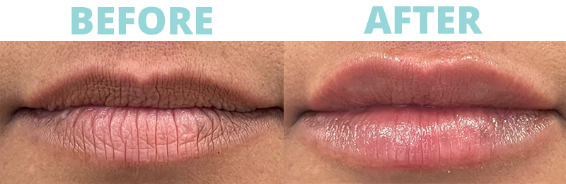 Lip Filler