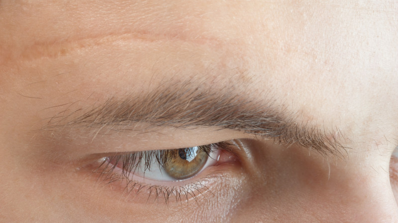 How to Reduce the Appearance of Scars