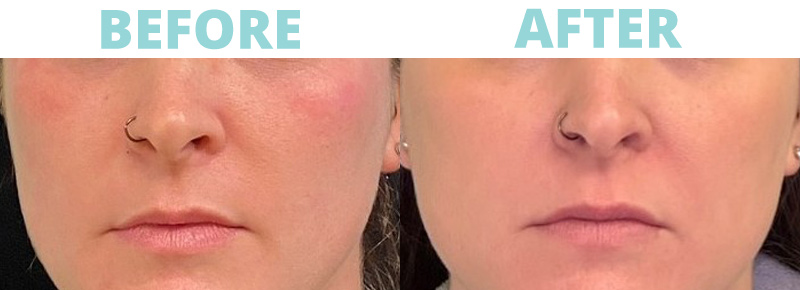 Discover the Sciton Moxi Laser: A Gentle Way to Rejuvenate Your Skin