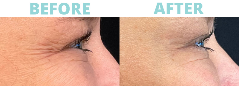 What Is Botox?