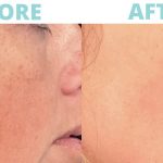 Profractional Therapy in Kernersville, North Carolina