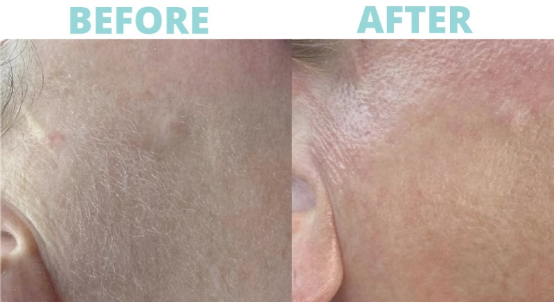 Dermaplaning