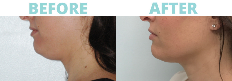 kybella 3 Under Eyes