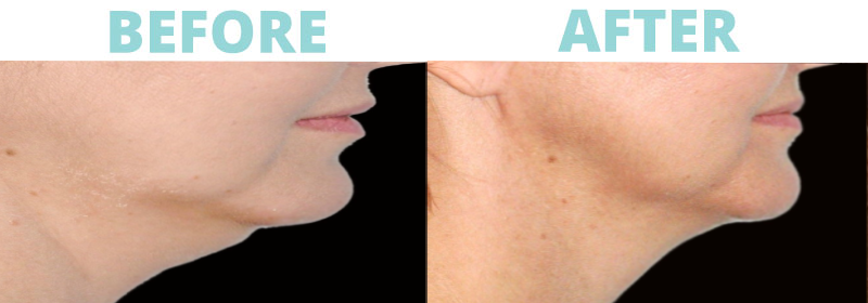 kybella2 Under Eyes
