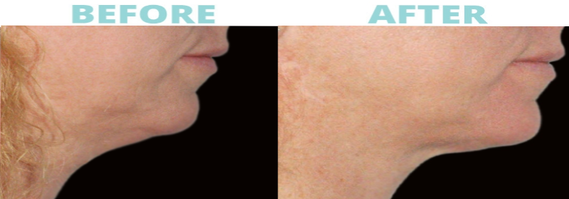 res-kybella Under Eyes